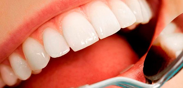 Что такое виниры — плюсы и минусы винирования зубов