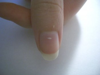 появление белых пятен на ногтях